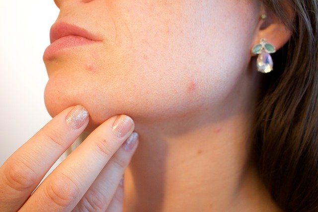 Acne: Causes, Symptoms and Treatment