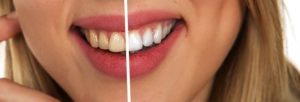 DENTAL HYGIENE TIPS